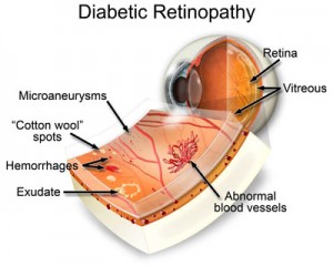 Diabetic Retinopathy Macroom